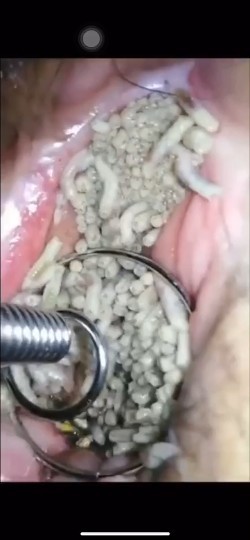 炸裂 ！17岁女生阴道长蛆？（惧进）我密集恐惧症犯了！